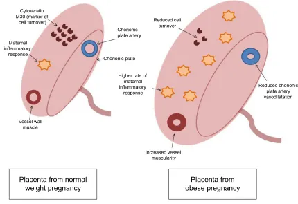 Figure 2 Placental modifications in obese pregnancy. Notes: in obese pregnancy, reduced placental cell turnover (as demonstrated by lower detected levels of apoptosis marker) (cytokeratin M30) may contribute to overall larger size of placenta