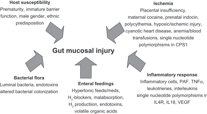 Figure 1 Current epidemiological and experimental information on necrotizing enterocolitis supports a multifactorial model of disease