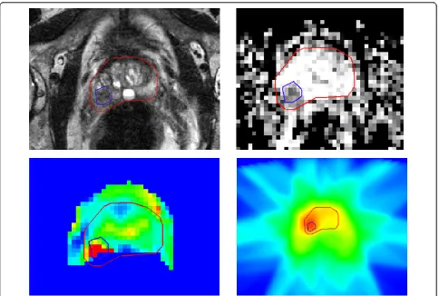 Figure 1 Example of the delineation of the macroscopic tumor area (GTV) on T2 weighted MRI (a), an apparent diffusion coefficientmap derived from diffusion-weighted MRI (b) and a Ktrans parameter map obtained from dynamic contrast-enhanced MRI (c) and thedose distribution (d).