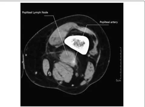Figure 1 An MRI showing the popliteal metastasis