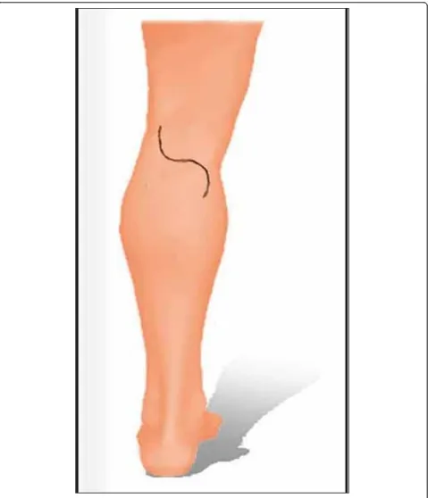 Figure 6 Incision for popliteal lymph node dissection