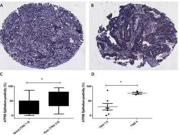 Figure 6. ATP5B expression is increased in the tumour epithelium of poor responders. ATP5B expression was assessed bypositivity in the epithelium is significantly increased in tumours of patients with no evidence of regression (TRG 5), when compared to pat