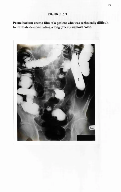 FIGURE 5.3Prone barium enema film of a patient who was technically difficult