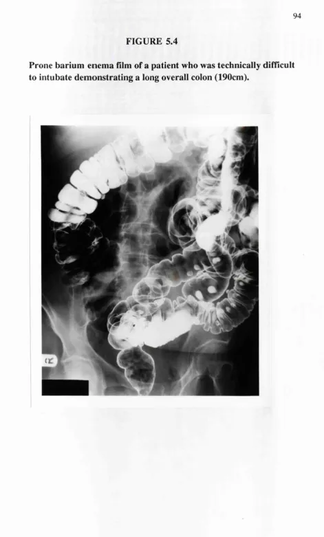 FIGURE 5.4Prone barium enema film of a patient who was technically difficult