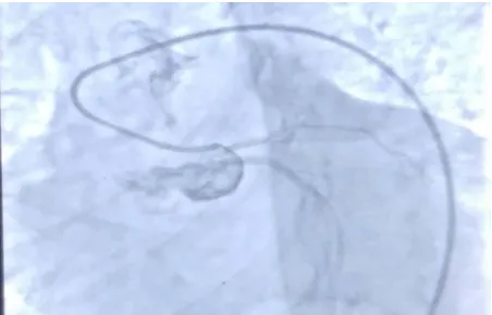 Figure 3. Coronary angiography image showing origin of right coronary artery and left main coronary artery from right sinus