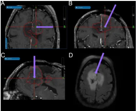 Fig 2. Neuronavigation-guided anatomic images of biopsy tissue sampling sites. Neuronavigation-guided T1-weighted images of the biopsy tissue sampling site at (A) axial, (B) coronal, and (C) sagittal views
