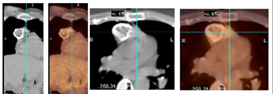 Figure 2 Computed tomography (CT) scan showing a 3.9 cmrim calcified right anterior mediastinal mass