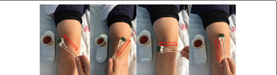 Fig. 3 Crossbow needle treatment. The red arrows indicate the rolling directions of the skin needle