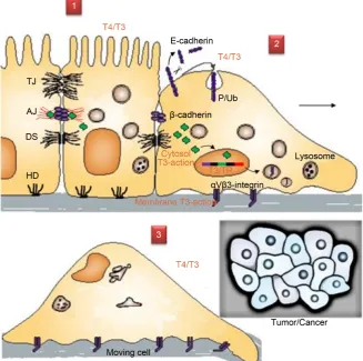 Figure 1. E-cadherin dysfunction and cancer. In a differentiated and established epithe-therefore acts as an invasion suppressor system (stage 1)