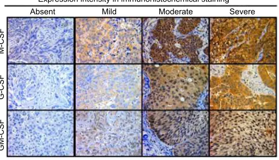 Figure 1 Expression of M-CSF, G-CSF, and GM-CSF in bladder cancer cells using immunohistochemistry