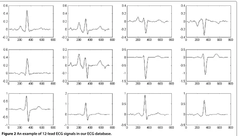 Figure 2 An example of 12-lead ECG signals in our ECG database.