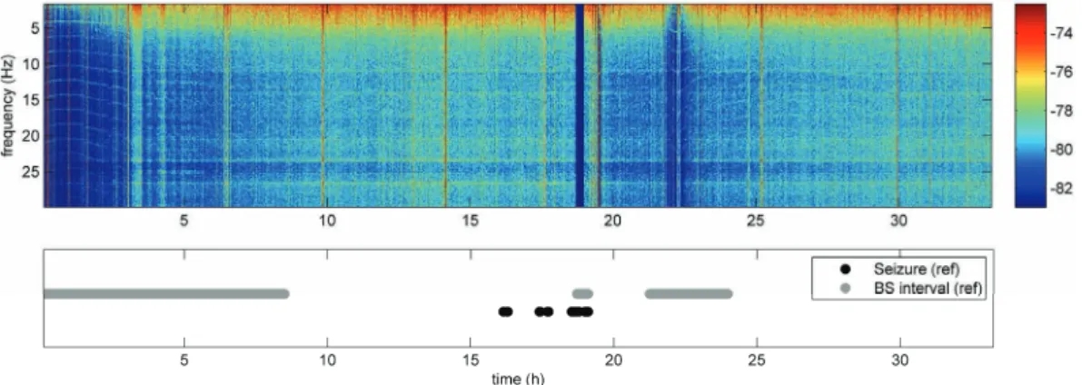 Figure 13: Time-frequency plot of 32h of EEG from a post-asphyctic baby with  episodes of BS and seizures marked