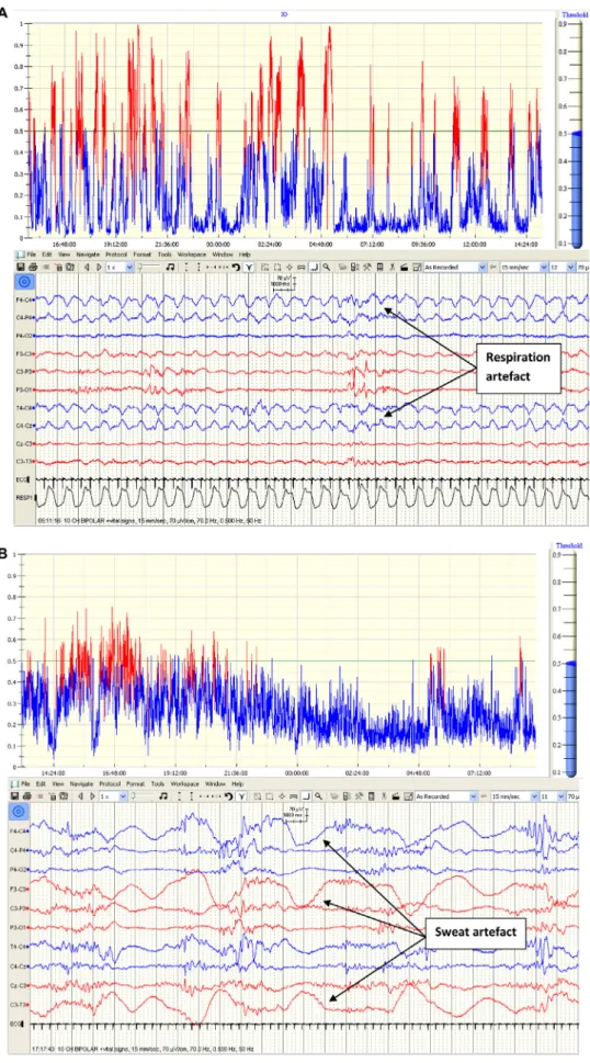 Fig. 4. Effects of respiration and sweat artefacts on seizure probability output. (A) Highly rhythmic respiration artefact (lower panel) produces high probability peaks on SDA output graph (upper panel)
