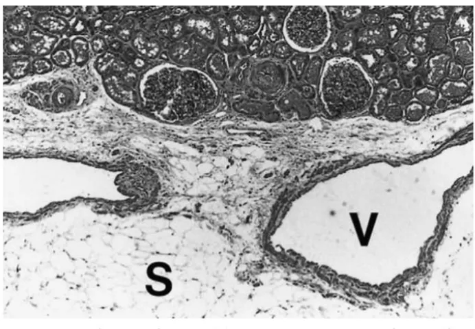 Figure 5 Sinus fat devoid of capsule with an adjacent vein 
