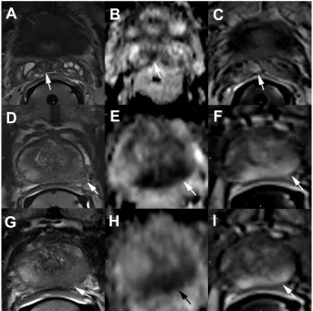 Figure 1 Example of extracapsular extension detected on multiparametric prostate MRI.the prostatic capsule and there is an associated loss of capsular definition.signal abnormalities on T2W, DWI, and DCE images at the same region, the confidence in cancer 