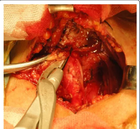 Figure 1 Thyroid microcarcinoma was discovered by screeningwith ultrasonography.