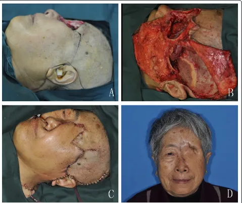 Figure 3 The combination of cervicofacial rotation flap and TMF. A. The design of the TMF and cervicofacial flap after the tumour wasresected