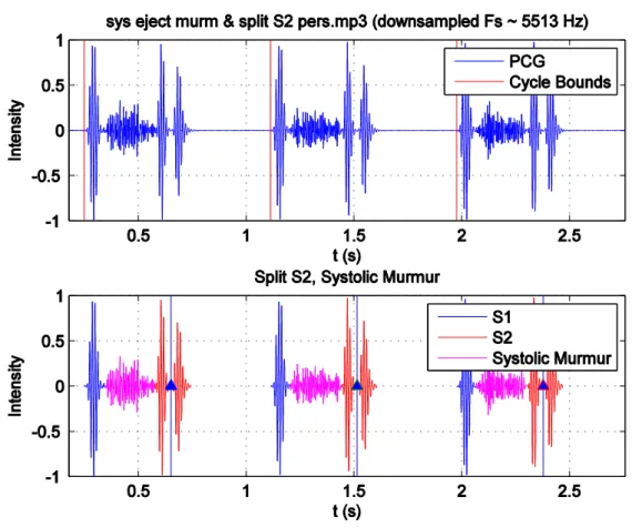 Figure 4-3: Graphical segmentation results for a PCG with systolic murmurs and split S2  [chp4_seg.m]