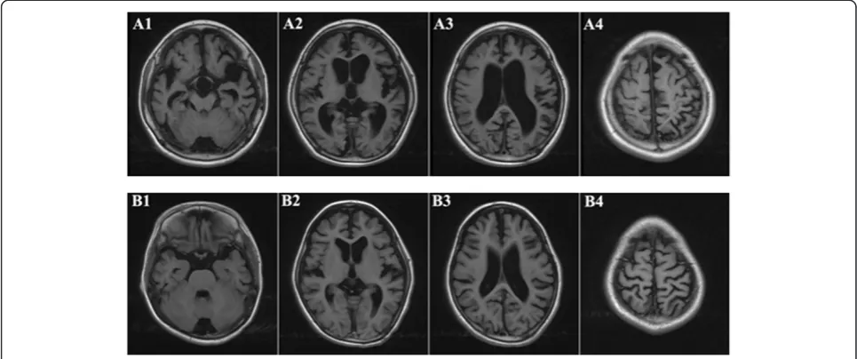 Figure 2 Brain MRI of the two prodbands (A: brother 10 years old; B: sister 9 years old): Axial T1-weighted images showed that thehemisphere sulci and schizencephaly general broadened and deepened