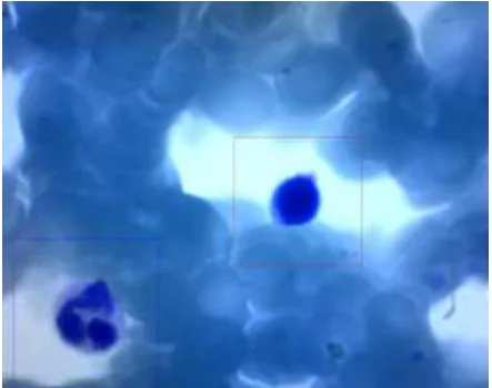 Fig. 5. Segmented Neutrophil and Lymphocyte detected. 