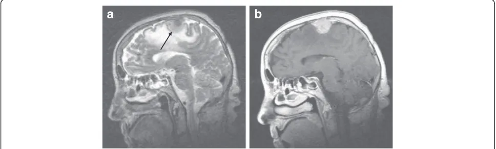 Fig. 1 A sagittal T2-weighted spin echo image showing a cortical meningioma in the motor area (arrow) surrounded by extensive oedema (a).On T1-weighted spin echo image with contrast application (b), the tumour enhanced homogenously