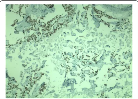 Fig. 2 Histological sample of angiomatous meningioma with cordsand sheets of malignant cells from pulmonary carcinoma infiltratingthe meningioma tissue (haematoxylin and eosin staining, originalmagnification ×200)