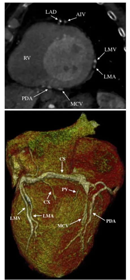 Figure 4 Evaluation of cardiac venous anatomy. Baseline cardiacCT images from a prospective high pitch scan illustrating cardiacvenous anatomy in a chronic heart failure patient in the mid-LVmultiplanar reformatted short axis view (top) and in a three-dime