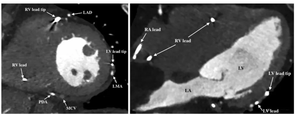 Figure 5 Evaluation of LV lead position. Six months follow-up cardiac CT acquisition from the same patient as in Figure 4