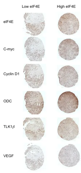 Figure 3panel) eIF4ERepresentative example of human breast cancer specimens from TMA3 that expressed either low (left panel) or high (right Representative example of human breast cancer specimens from TMA3 that expressed either low (left panel) or high (ri