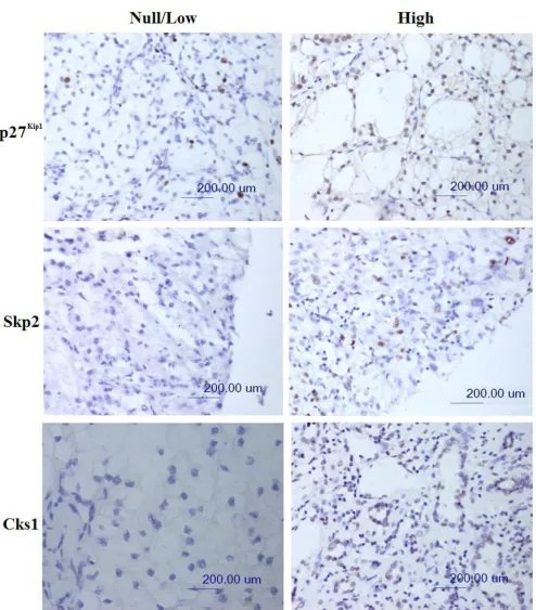 Figure 1, Skp2 and Cks1(immunohistochemical staining; original magnification ×200; scale bar, 200 Expression of p27Expression of p27Kip1, Skp2 and Cks1