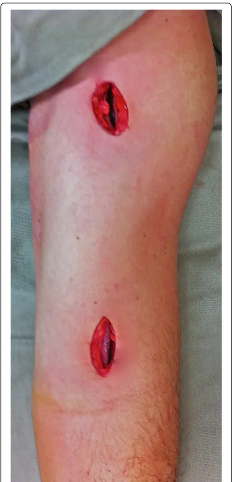 Figure 4 Surgical incisions for minimally invasive bridgeplate osteosynthesis.