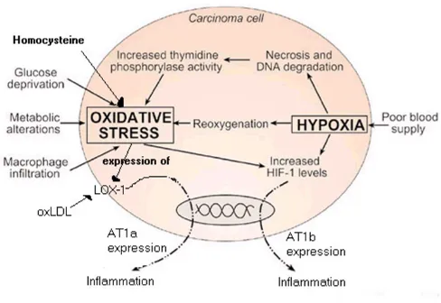 Figure 1AT1 expression in cancerAT1 expression in cancer. A cycle of oxidative stress (enhanced by homocysteine and ox-LDL) and hypoxia on the growing tumour boundary co-operatively promotes AT1 expression, leading to inflammation-associated angiogenesis, invasion, metas-tasis and immune suppression.