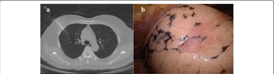Fig. 1 a The puncture needle (Temno Coaxial Introducer Needle, Care Fusion, PP1910) was inserted under the CT-guided imaging
