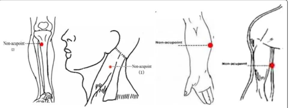 Figure 3 Locations of acupoints: non-affected meridian acupuncture group (NMA).