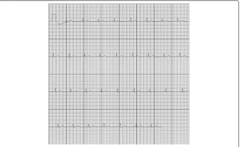 Fig. 1 An electrocardiogram (ECG) recorded by the AliveCor device showing sinus rhythm