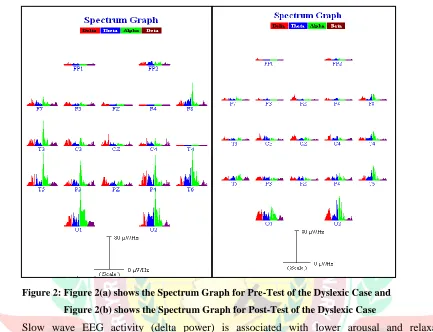 Figure 2: Figure 2(a) shows the Spectrum Graph for Pre-Test of the Dyslexic Case and 