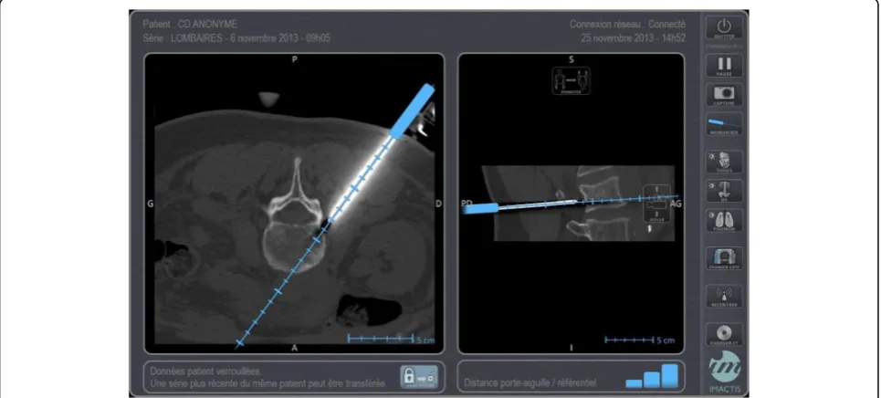 Fig. 1 Screenshot of a computed tomography-guided percutaneous biopsy of a spinal lesion