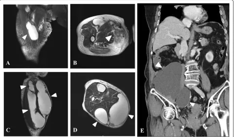Fig 1 Image findings.multiloculated and lobulated lesions mainly involving the posterior compartment ( a A T2-weighted coronal view magnetic resonance image (MRI) of the right thigh shows a cystic lesion mainly involvingthe anterior compartment, especially
