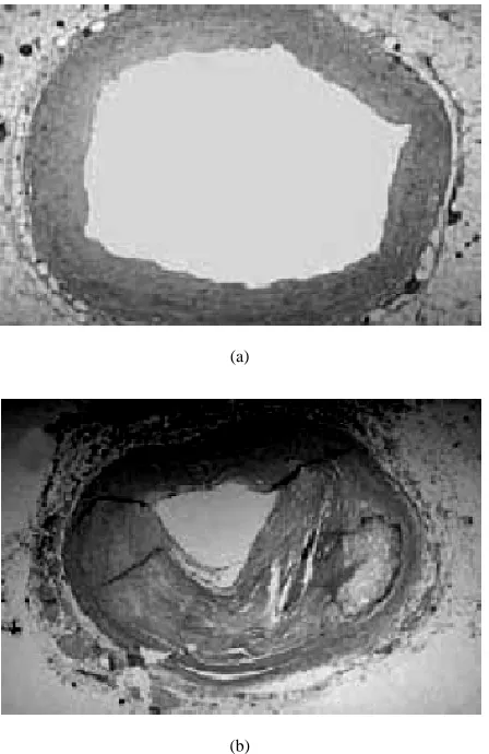 Figure 1. (a) Cross section of a normal artery lumen. The endothelial cells neighbour the lumen and no intimal thick- cells them to bulge into the lumen restricting blood flow