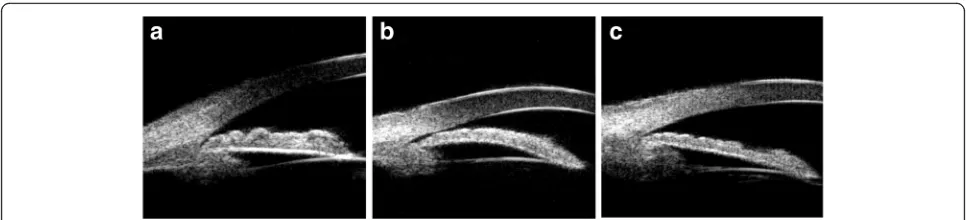 Fig. 2 UBM-based angle closure configuration classification.body. a Thickening of the peripheral iris; b iris bombe; c anterior rotation of the ciliary UBM ultrasound biomicroscopy