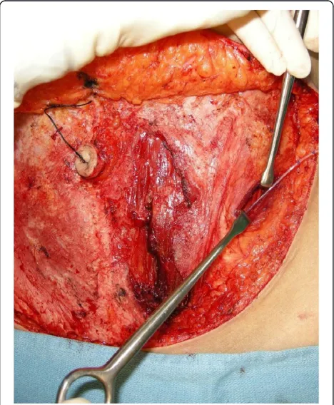 Figure 2 Triangle of Petit landmarks are identified through thesame abdominal incision used to harvest the abdominal flap.