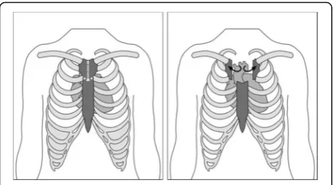 Fig. 2 Division and transection of the sternum in a manubrium-limitedministernotomy