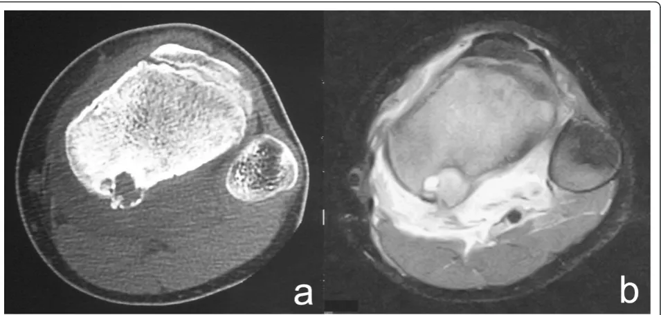 Figure 1 A 13-year-old boy with a solid ABC in the left tibia. a. CT showed an osteolytic expansive lesion with cortical thinning