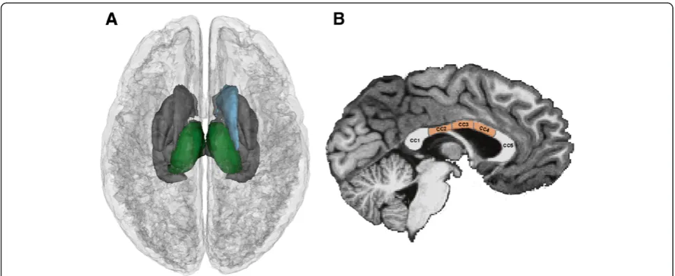 Figure 2 Group differences in subcortical regional brain volumes: superior view (A) and sagittal view showing the divisions for thecorpus callosum (B)