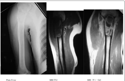 Figure 1 Plain X-ray radiographs and MRI on the first examination. Osteolytic hypertranslucency accompanied by pathological fracture wasobserved in the proximal humerus on plain radiographs