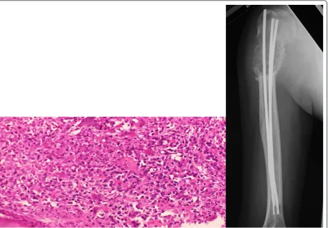 Figure 2 Histopathology on biopsy and plain radiographics image at the completion of preoperative chemotherapy