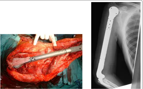Figure 3 Intraoperative findings and a postoperative plain radiographics images. Total humerus replacement was performed, and anHMRS artificial joint for tumor treatment was inserted and hung using an artificial ligament