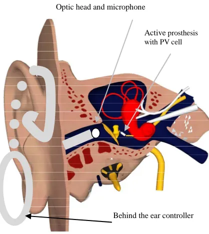 Figure 6. Active prosthesis and its parts. 