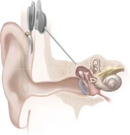 Figure 7. Typical cochlear implant and location of processor. 