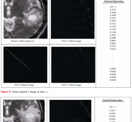 Figure 9. Tumor patient 2 image at time t1 .